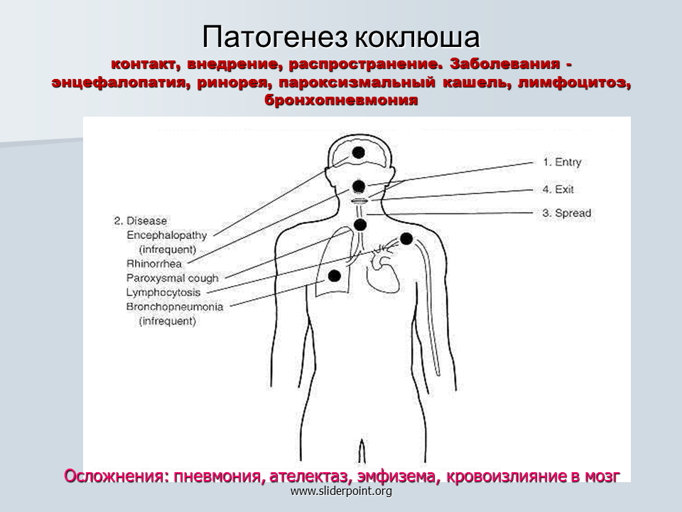 Патогенез коклюша. Коклюш схема. Коклюш этиология патогенез. Патогенез коклюша схема.