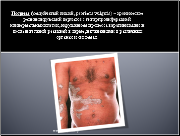  ( , psoriasis vulgaris)        ,        ,      .