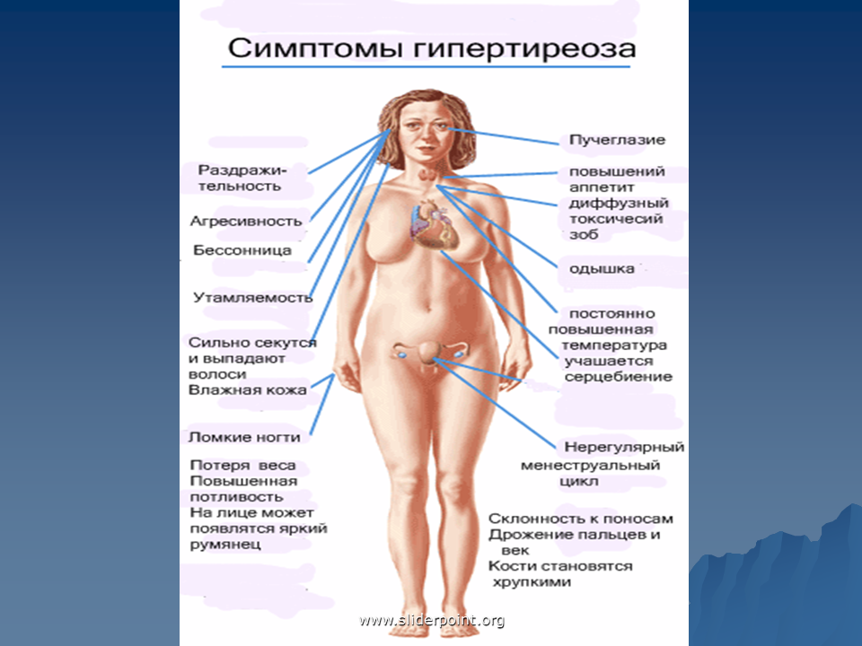 Щитовидная железа тиреомегалия. Половая система при гипертиреозе. Клинические проявления при гипотиреозе и гипертиреозе. Заболевания щитовидной железы (гипертиреоз, тиреотоксикоз)..