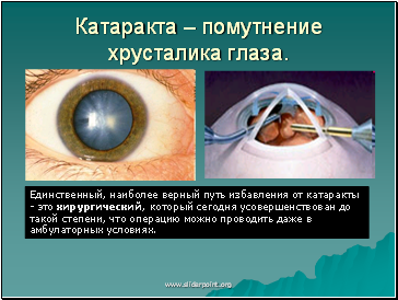 Катаракта – помутнение хрусталика глаза.