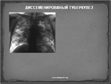 Диссеменированый туберкулез