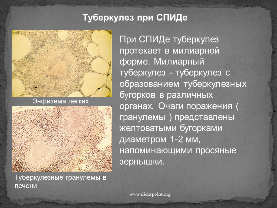 Туберкулезный латынь. Туберкулез и ВИЧ презентация. Туберкулез при ВИЧ презентация. Туберкулез легких при ВИЧ.