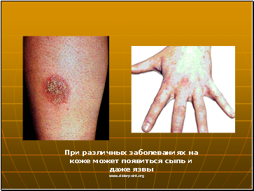 При различных заболеваниях на коже может появиться сыпь и даже язвы