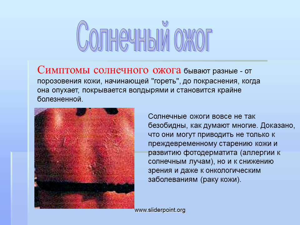 Крайне болезненно. Симптомы солнечного ожога. Солнечный ожог степени.